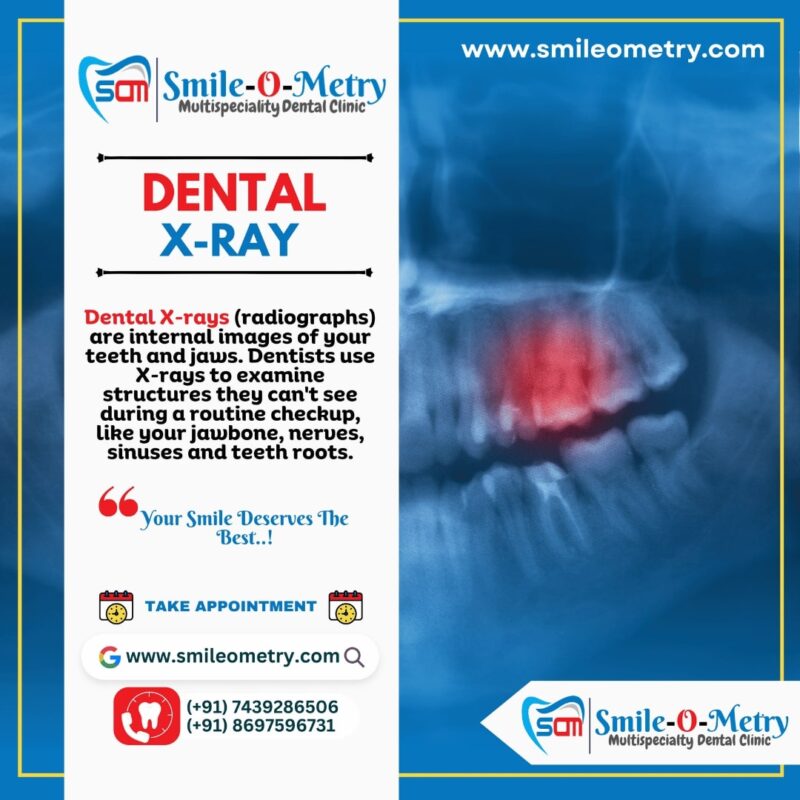 Dental X-Ray