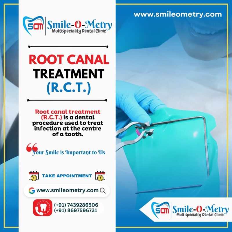 Root Canal Treatment (RCT)