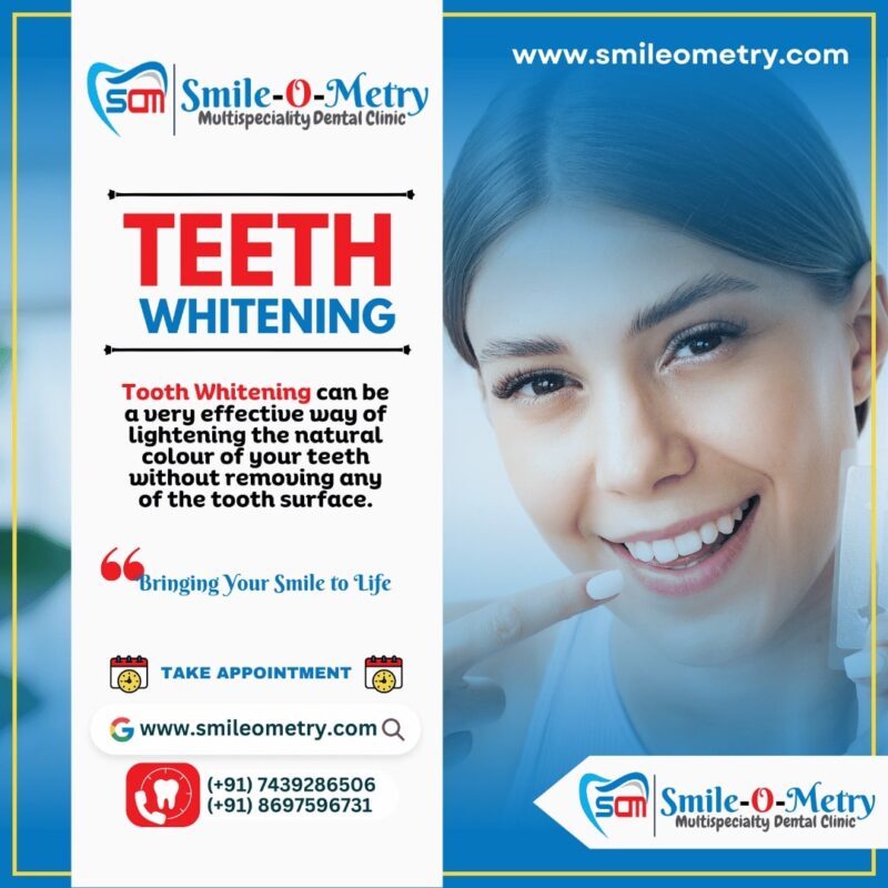 Teeth Whitening